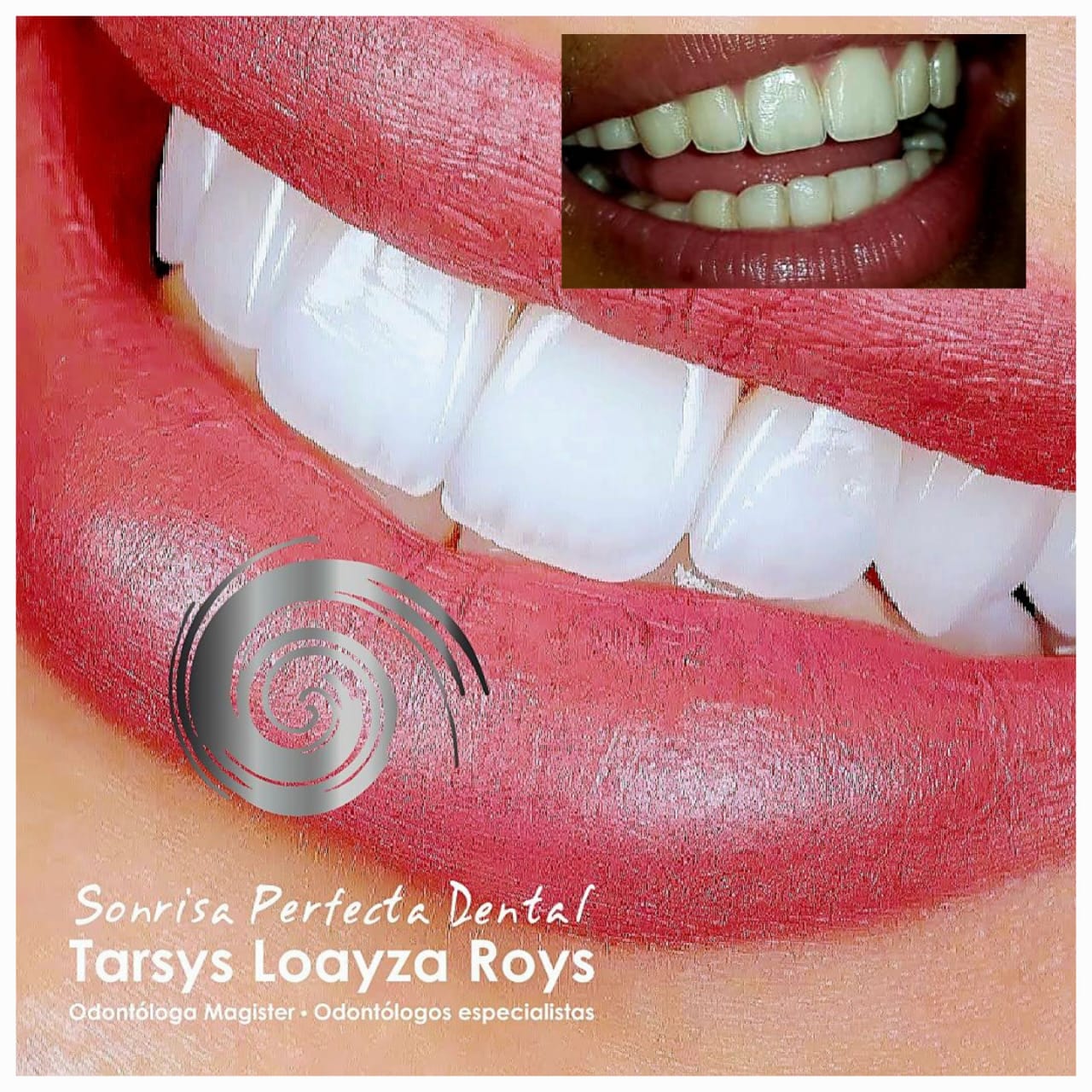 Antes y despues Blanqueamiento dental laser