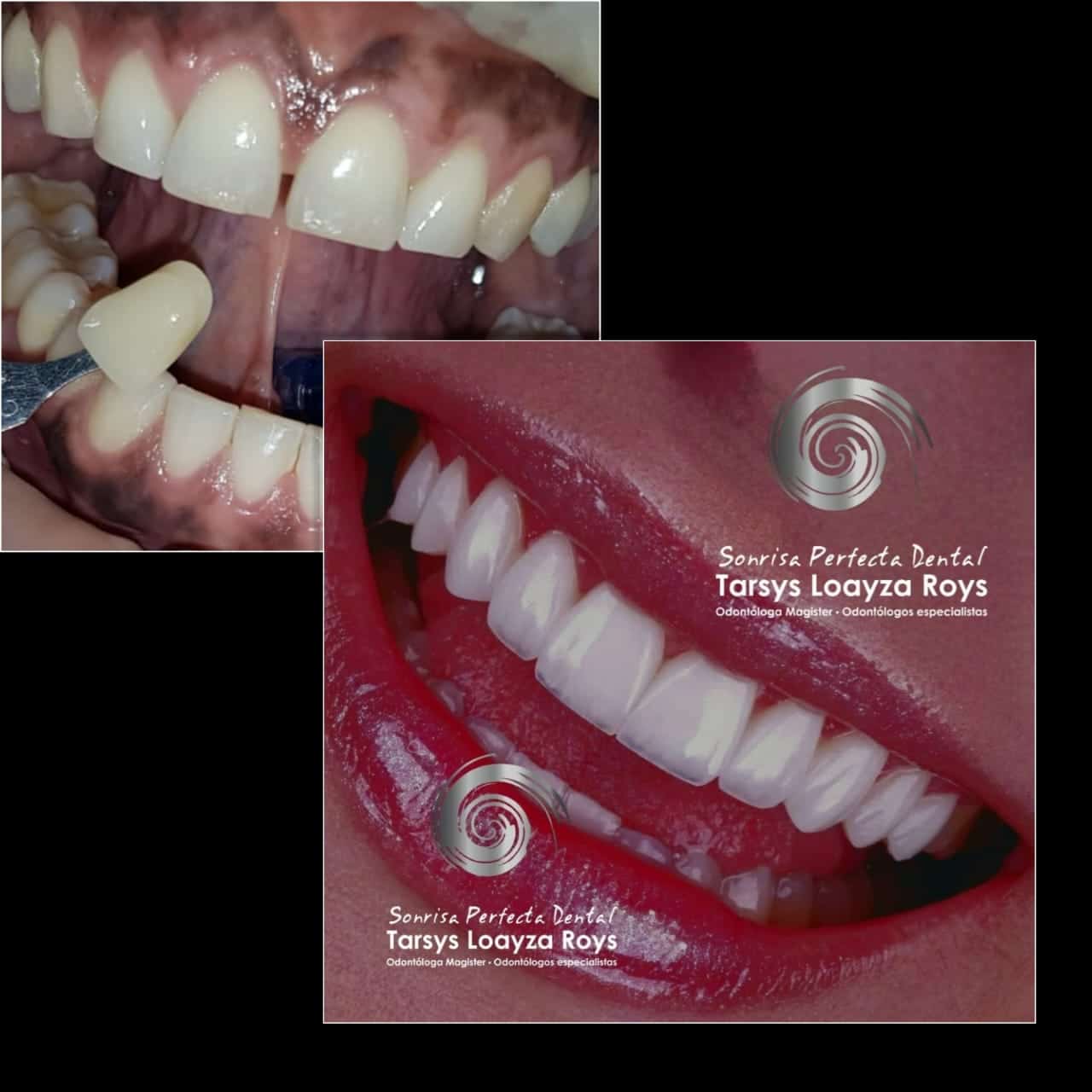 veneers