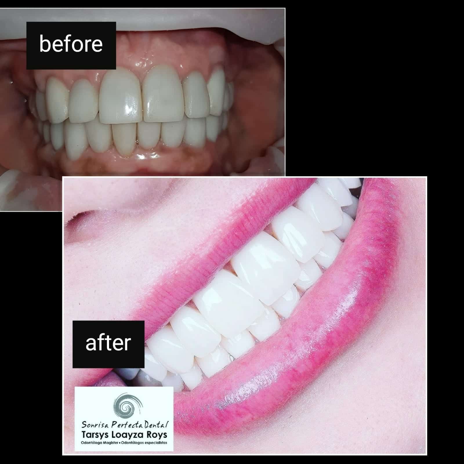 Sonrisa Renaissance Hollywood antes y despues